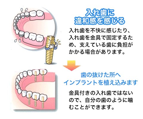 入れ歯に違和感を感じる→歯の抜けたところへインプラントを植え込みます